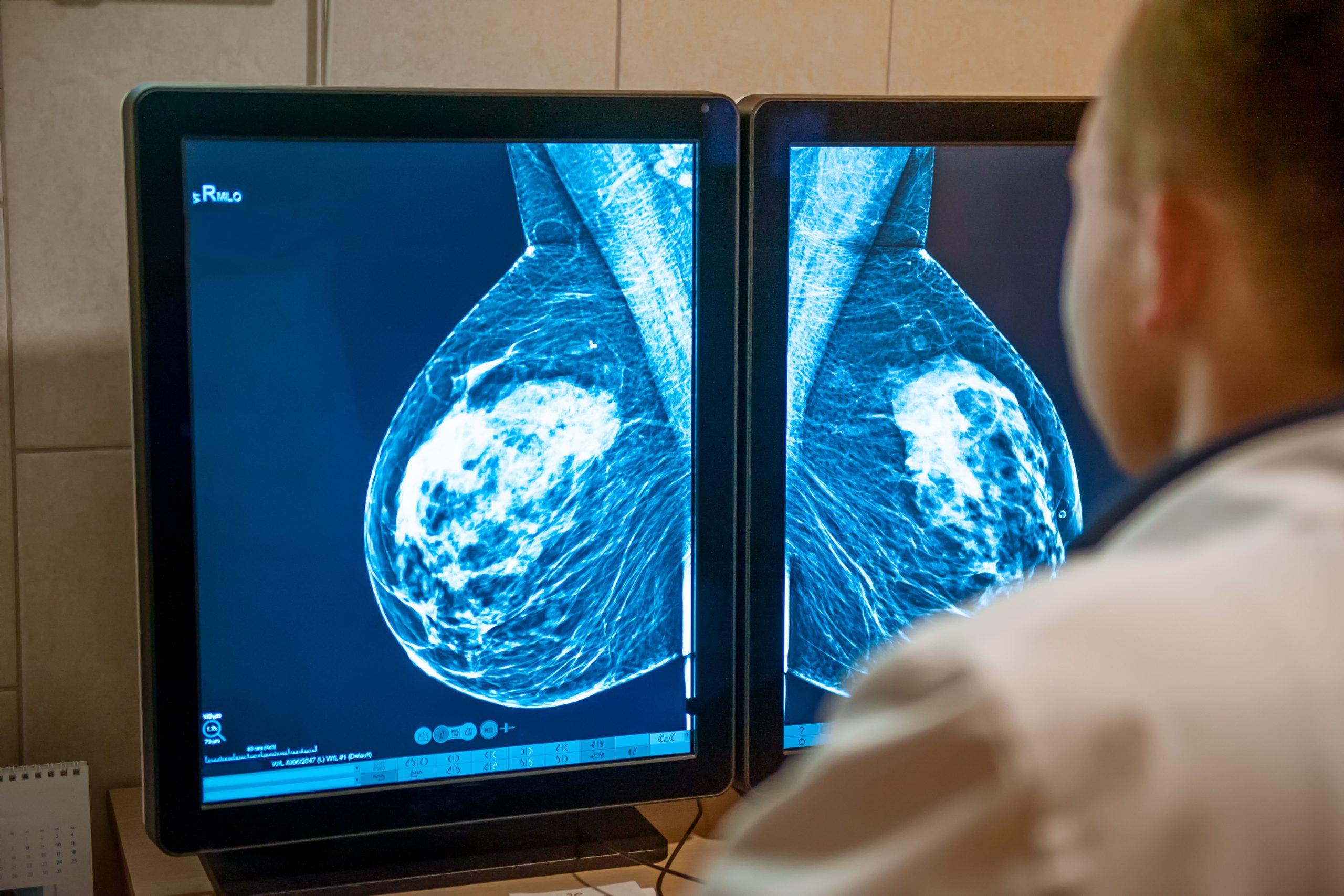Doctor examines mammogram